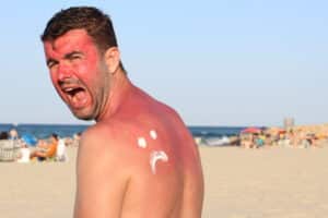 Ein Mann am Strand mit Sonnenbrand im Gesicht und auf dem Rücken