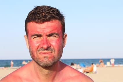 Ein Mann am Strand zeigt die Symptome eines Sonnenbrand