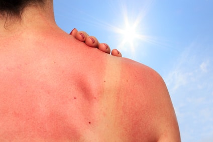 Eine Frau zeigt auf Ihrem Rücken den Verlauf des Sonnenbrand