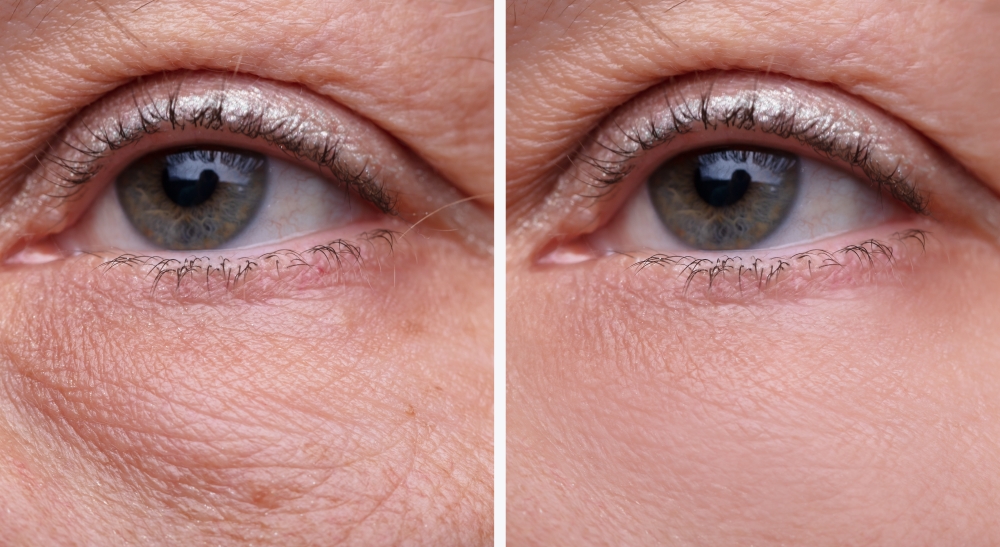 Tipps gegen Dunkle Augenringe